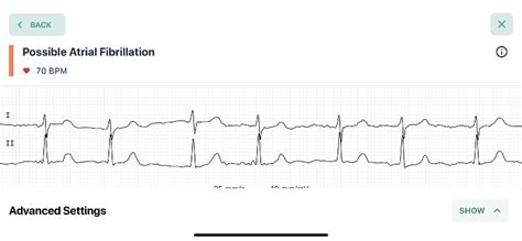 Kardia monitor - if it says ‘Possible... - Atrial Fibrillati...