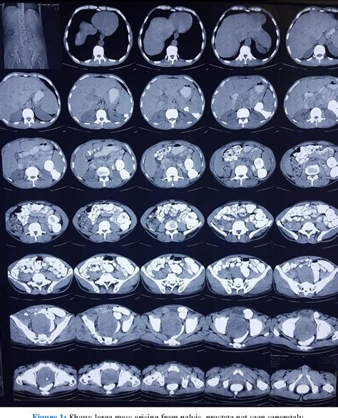 Figure 1 From Solitary Fibrous Tumour Of Pelvic Soft Tissue Mimicking A