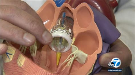 Heart Valve Procedure TAVR Offers New Hope Alternative To Open Heart