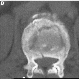 Patient A Male 52 Years Old Was Hospitalized For 1 Day With Low Back