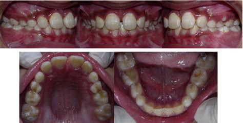 Four Months Post Retention Intraoral Photographs Download Scientific Diagram