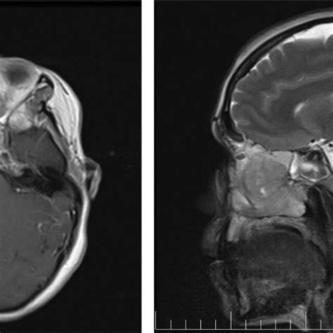 Pretreatment Mri Soft Tissue Mass In The Ethmoidal Sinus Nasal