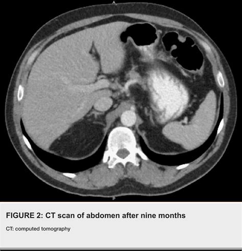 Figure 2 From Liver Abscesses Caused By Streptococcus Intermedius In An Immunocompromised