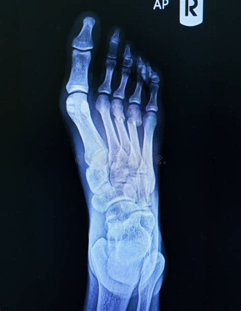 X Ray Foot Oblique View Showing Fracture Neck Of Metatarsal Bone