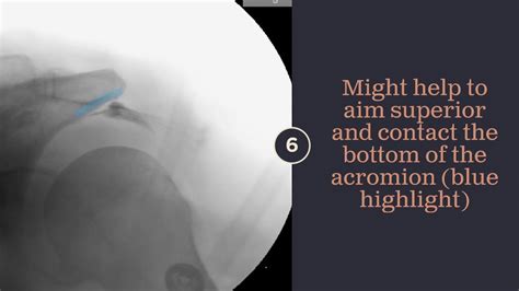 Subacromial Shoulder Injection