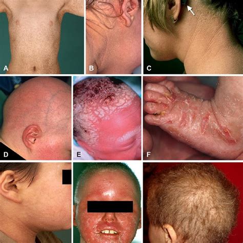 Clinical Examples Of Keratinopathic Ichthyosis Superficial Blister