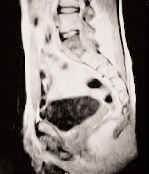 Figure From Sacral Chondroblastic Osteosarcoma Misdiagnosed As