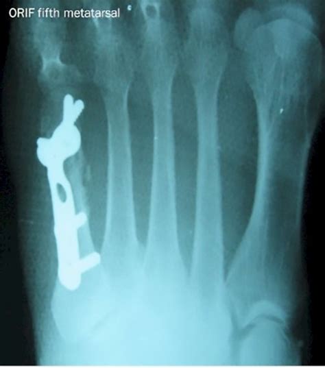 Metatarsal Fractures | Causes and treatment options | MyFootShop.com