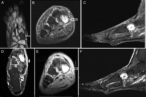 Primary Intraosseous Malignant Peripheral Nerve Sheath Tumor Of The