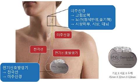 Figure From Vagus Nerve Stimulation For Patients With Epilepsy