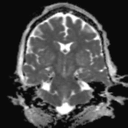 Ethylene Glycol Toxicity Image Radiopaedia Org