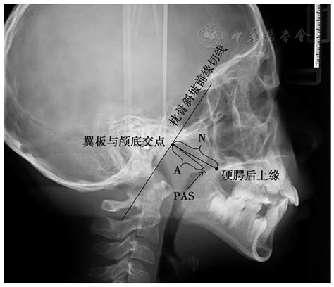 儿童腺样体肥大的诊断与筛查技术进展现状