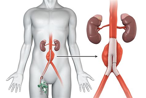 Abdominal Aortic Aneurysm Treatment Sydney Thoracic Aorta Taa Sydney