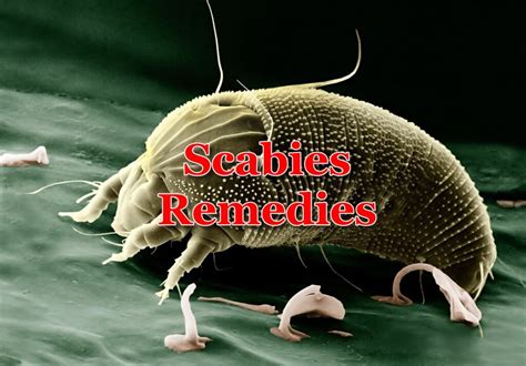 10 Home Remedies for Scabies - Home Remedies App