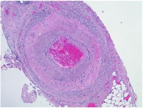 Giant Cell Arteritis Clinical Concise Medical Knowledge