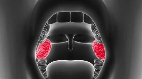 Cáncer de amígdalas síntomas tratamiento supervivencia y más