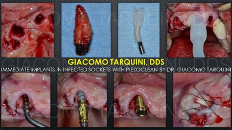 Piezoclean By Dr Giacomo Tarquini E Impianti Post Estrattivi Immediati