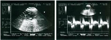 Sonographic Detection Of PDA Before Surgical Correction Of The Defect