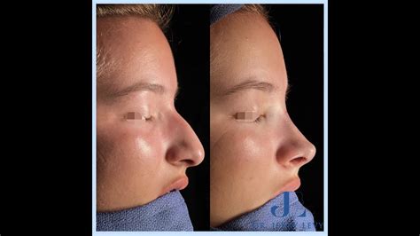 Rhinoplastie de préservation type Teorhinoplasty YouTube