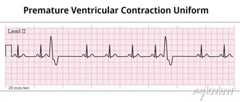 Ecg Premature Ventricular Contraction Uniform Unifocal 8 Posters