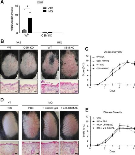 Oncostatin M Overexpression Induces Skin Inflammation But Is Not