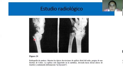 Fracturas De Mu Eca Traumatolog A Reforzamiento Acad Mico Ucm