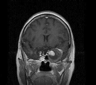 Supraclinoid Aneurysm- A Case Report - Sumer's Radiology Blog