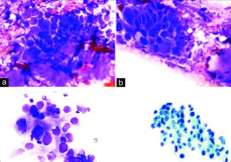 A Group Of Cohesive And Pleomorphic Tumor Cells Associated With A