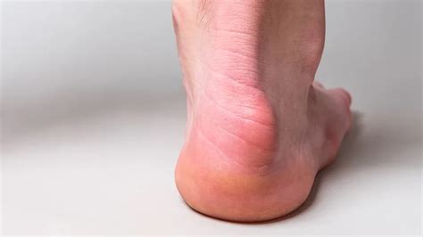 Haglund's Deformity; How To Diagnose and Treat It | Dr Bijan 4 Feet