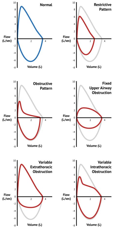 Upper Airway Obstruction Flow Volume Loop