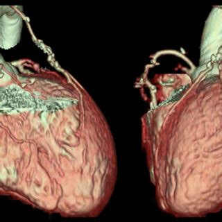 Postoperative Coronary Computed Tomography Angiography On