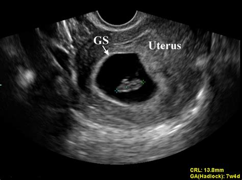 fetal parameters obstetrics medbullets step