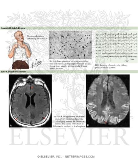 Transmissible Spongiform Encephalopathy