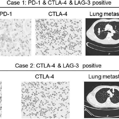 A Representative Case No 1 A Patient With PD 1 CTLA 4 And LAG 3