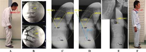 Case Cbva Chin Brow Vertical Angle Cg Center Of Gravity Hp Hilus