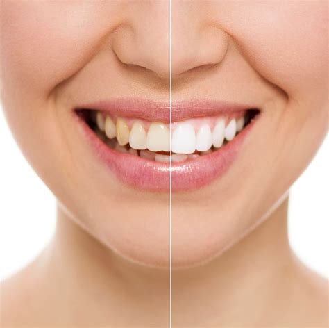 Professional Teeth Whitening