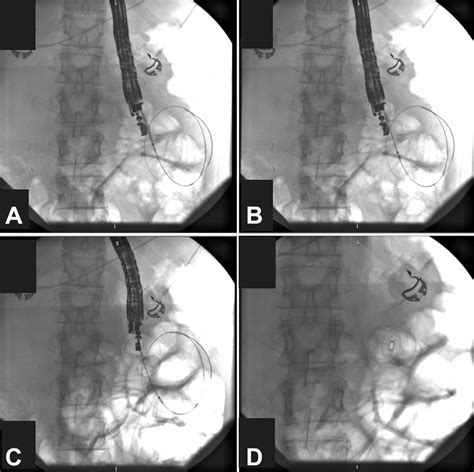 A Advancement Of Lumen Apposing Metal Stent Lams Into The Obstructed