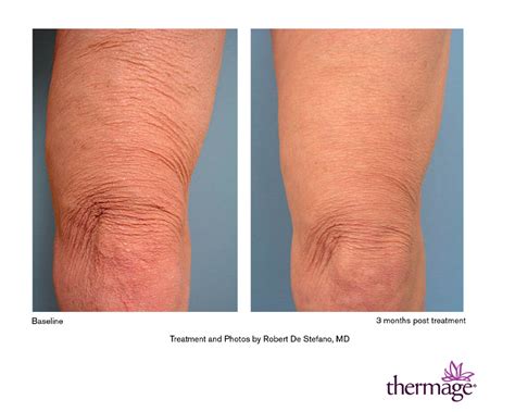 Thermage Skin Tightening Laser Spa Group