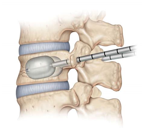 Vertebroplastie Kyphoplastie Cavity Debulking