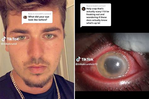 I Took A Quick Nap — And A Flesh Eating Parasite Left Me Blind In One Eye