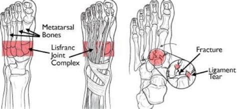 Physical Therapy For A Lisfranc Injury Mangiarelli Rehabilitation