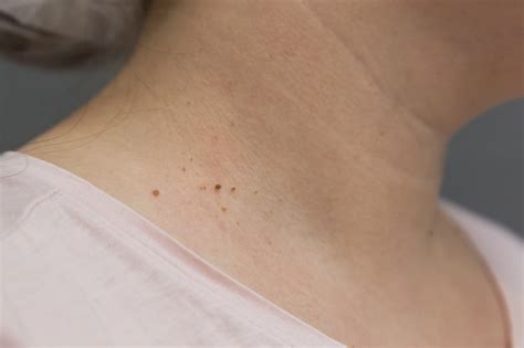 Как удалить папилломы в домашних условиях: лекарства, народные средства ...
