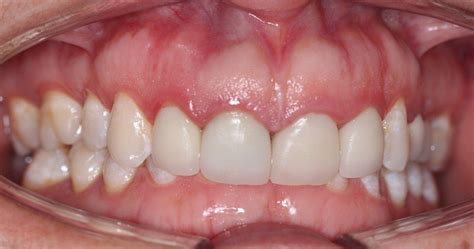 Tipos De Mordida Sobremordida Cl Nica Dental Casaus