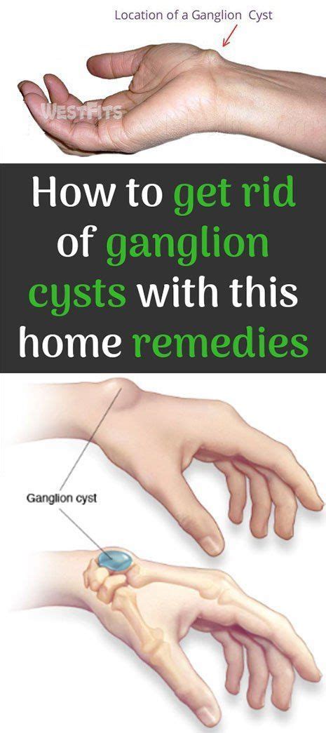 How To Remove Ganglion Cyst At Home Duane Pickrell Kapsels