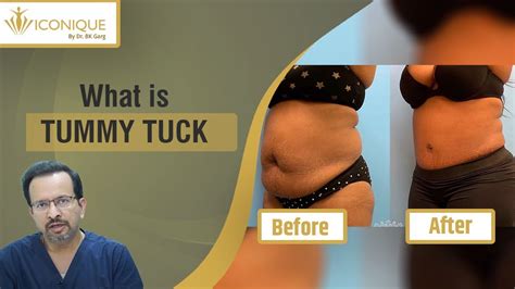 What Is Tummy Tuck Tuck Or Liposuction Dr B K Garg Youtube