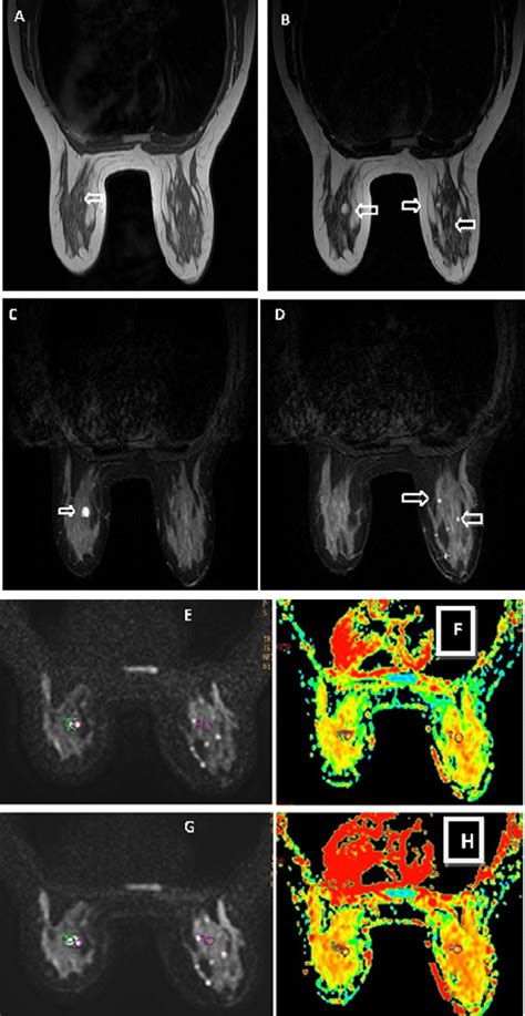 Mri T Wi T Wi Stirwi Ac Revealed Bilateral Multiple Lesions