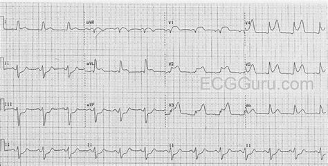 Wide Qrs Ecg