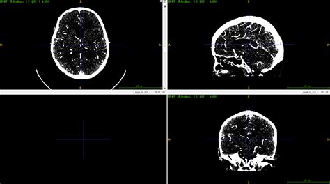 Dicom 医学图像与 Nii 标签数据处理nii数据 Csdn博客