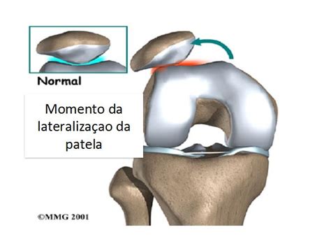 Instabilidade Femoro Patelar Dr Marcio Luiz Librelotto Rubin