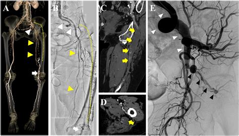 Successful Endovascular Therapy With Direct Tip Injection In Occlusive